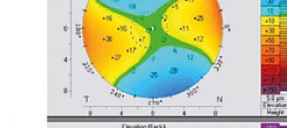 Mappa corneale Pentacam OD — elevazione anteriore occhio destro