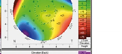 Mappa corneale Pentacam OS — elevazione anteriore occhio sinistro