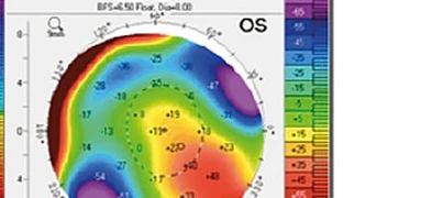 Mappa corneale Pentacam OS — elevazione posteriore occhio sinistro