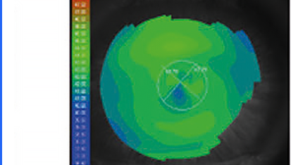 Axial Map OD — topografia corneale assiale occhio destro