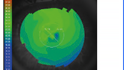 Axial Map OS — topografia corneale assiale occhio sinistro
