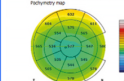 Pachymetry Map OD — spessore corneale occhio destro