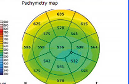 Pachymetry Map OS — spessore corneale occhio sinistro